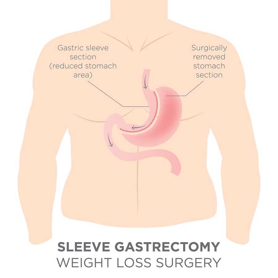 Gastric Sleeve Weight loss Surgery