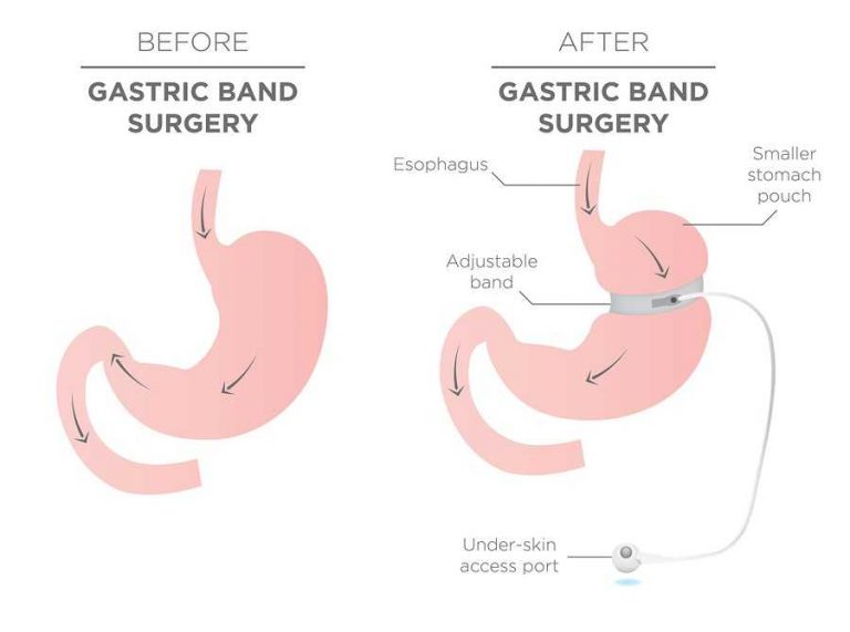 Gastric Sleeve Surgery Weight loss, Procedure & Cost