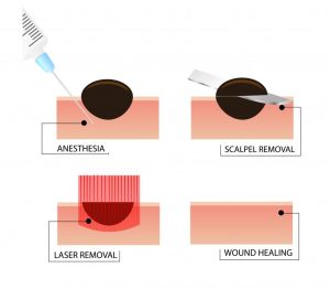 mole removal procedue